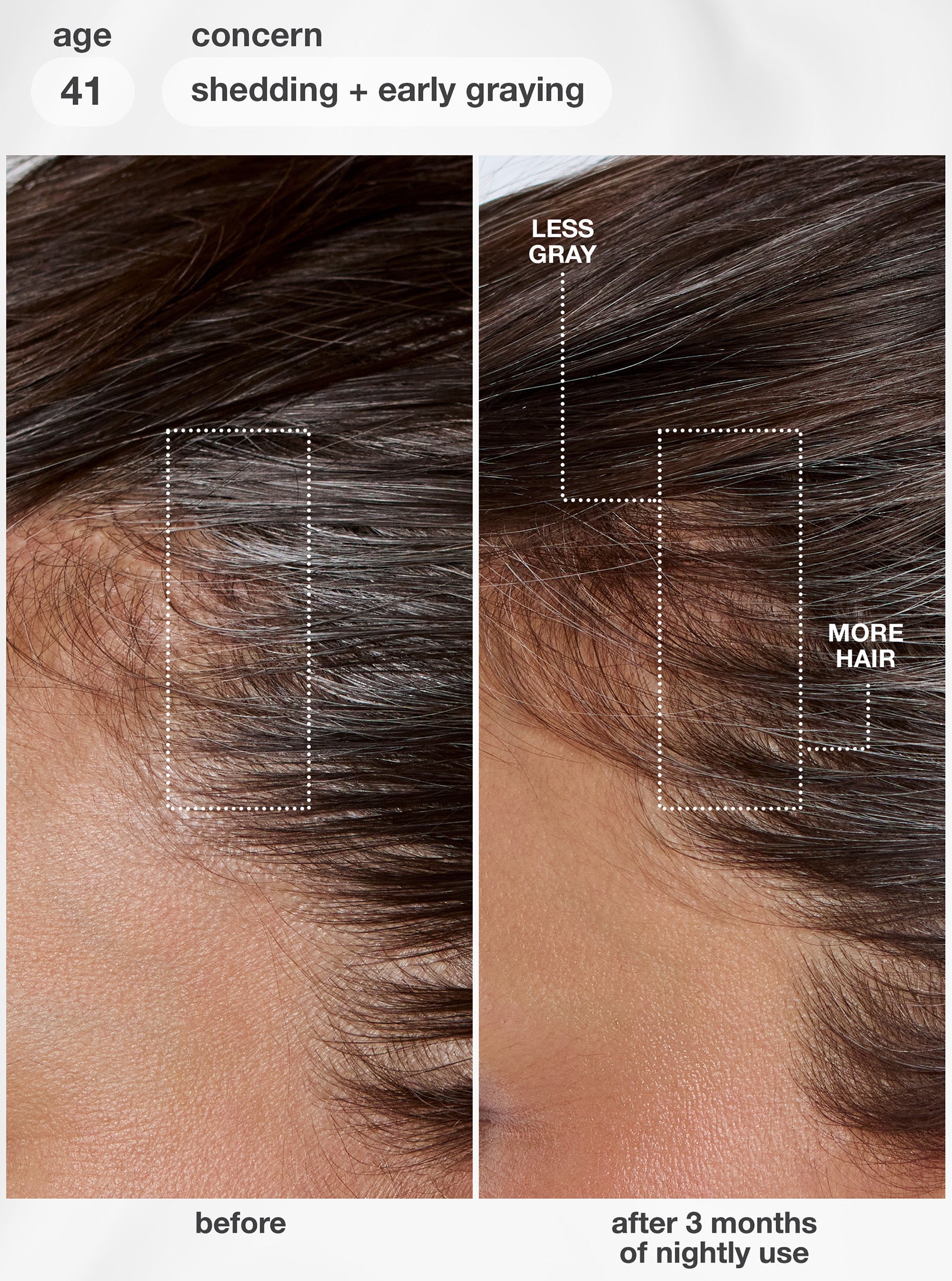 Before and after comparison of hair care product on scalp with less gray and more hair growth.